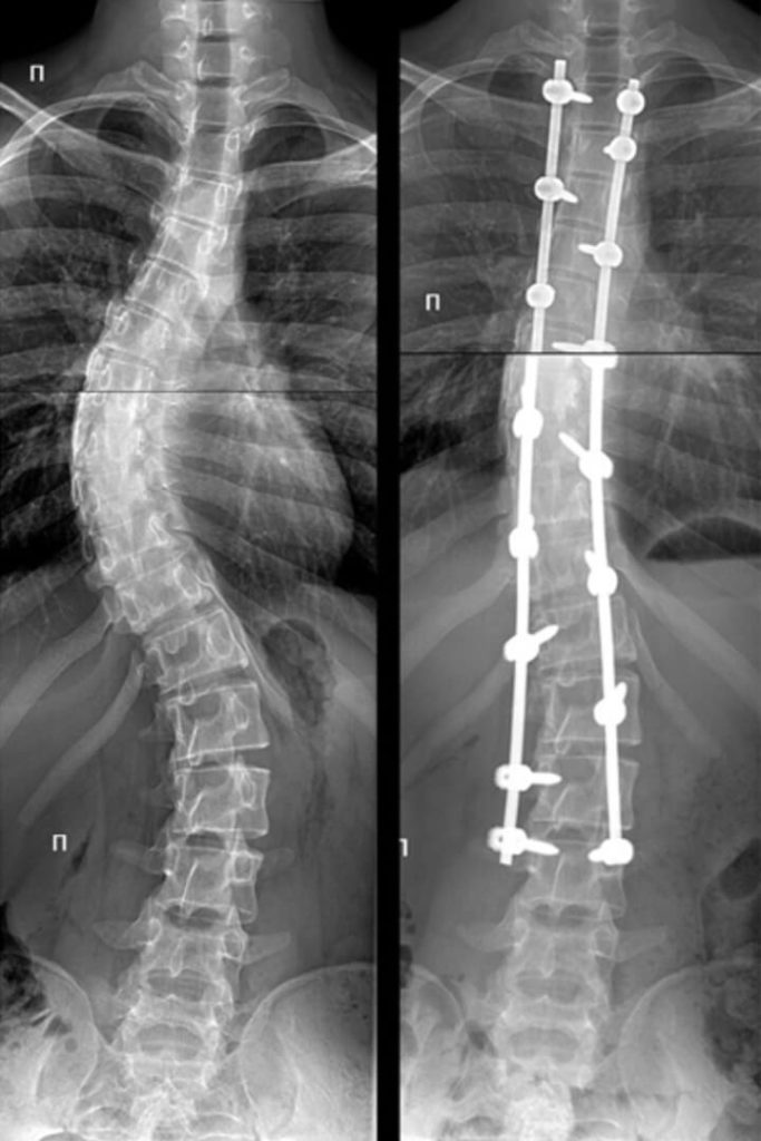 Сколиоз фото после операции