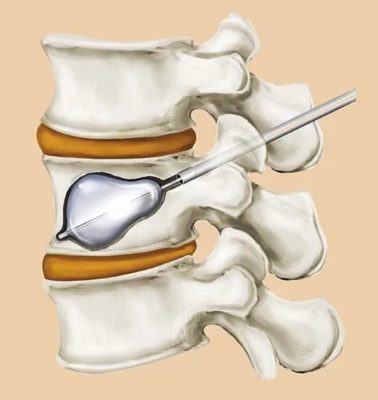 Перелом позвонка (fractura vertebrae)